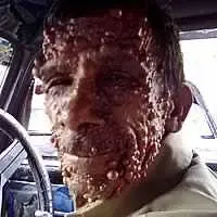 Fotografia del viso di un uomo affetto da neurofibromatosi dermica con crescita di tumori benigni a carico della pelle