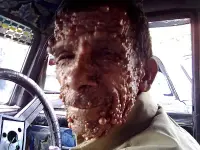 Fotografia del viso di un uomo affetto da neurofibromatosi dermica con crescita di tumori benigni a carico della pelle