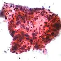 Grappolo di cellule squamose di carcinoma polmonare in cui si evidenzia la variazione nelle dimensioni e colorazione dei nuclei, i nucleoli piccoli e indistinti, lo scarso citoplasma, la cheratinizzazione