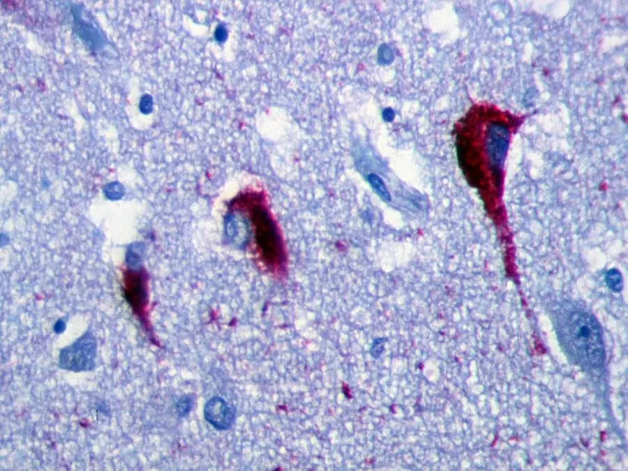 Degenerazioni neurofibrillari dovute alla proteina tau nell'ippocampo di un malato di Alzheimer